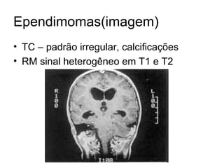 Ependimomas(imagem) 
• TC – padrão irregular, calcificações 
• RM sinal heterogêneo em T1 e T2 
 