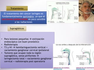 Tratamiento
El tratamiento del cáncer laríngeo es
fundamentalmente quirúrgico, ya que el
carcinoma epidermoide es poco sensible
a las radiaciones
Supraglóticos
• Para lesiones pequeñas  extirpación
endoscópica con buen pronóstico
• Radioterapia
• T3 y N1  hemilaringuectomía vertical +
vaciamiento ganglionar cervical ipsilateral
• Tumores que ocupan toda la región
supraglótica, senos piriformes 
laringectomía total + vaciamiento ganglionar
cervical + radioterapia post operatoria
 