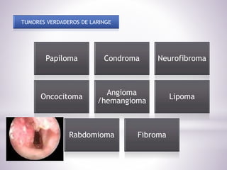 TUMORES VERDADEROS DE LARINGE
Papiloma Condroma Neurofibroma
Oncocitoma
Angioma
/hemangioma
Lipoma
Rabdomioma Fibroma
 