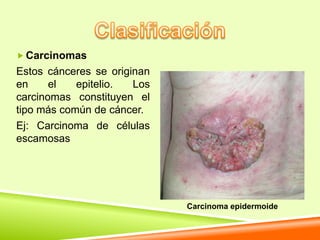  Carcinomas
Estos cánceres se originan
en     el   epitelio.  Los
carcinomas constituyen el
tipo más común de cáncer.
Ej: Carcinoma de células
escamosas




                             Carcinoma epidermoide
 