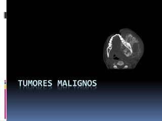 TUMORES MALIGNOS
 