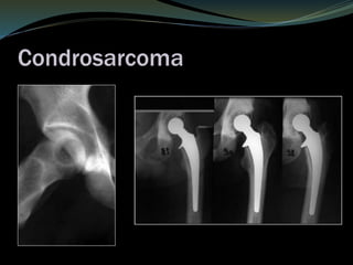 Condrosarcoma
 