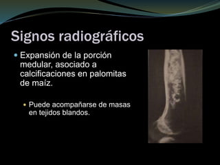 Signos radiográficos
 Expansión de la porción
medular, asociado a
calcificaciones en palomitas
de maíz.
 Puede acompañarse de masas
en tejidos blandos.
 