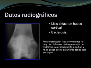 Datos radiográficos
 Lisis difusa en hueso
cortical
 Esclerosis.
fémur distal lesión lítica de contornos no
muy bien definidos, no hay presencia de
esclerosis, se extiende hasta la epífisis y
no se puede definir claramente dónde está
el margen.
 