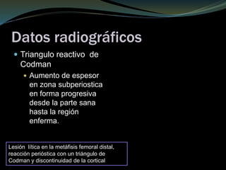 Datos radiográficos
 Triangulo reactivo de
Codman
 Aumento de espesor
en zona subperiostica
en forma progresiva
desde la parte sana
hasta la región
enferma.
Lesión lítica en la metáfisis femoral distal,
reacción perióstica con un triángulo de
Codman y discontinuidad de la cortical
 