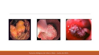 Tumores Malignos de Cólon e Reto – Junho de 2013.
 
