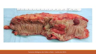 Tumores Malignos de Cólon e Reto – Junho de 2013.
 