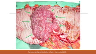 Tumores Malignos de Cólon e Reto – Junho de 2013.
 