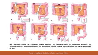 Tumores Malignos de Cólon e Reto – Junho de 2013.
(A) Colectomia direita, (B) Colectomia direita ampliada, (C) Transversectomia, (D) Colectomia esquerda, (E)
Sigmoidectomia, (F) Retossigmoidectomia, (G) Anastomose coloanal (direita, com reservatório em J) e (H) Amputação
de reto.
 