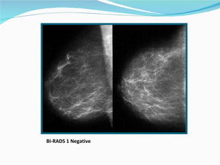 BI-RADS 1 Negative 