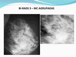 BI-RADS 3 – MC AGRUPADAS   