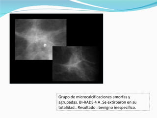 Grupo de microcalcificaciones amorfas y agrupadas. BI-RADS 4 A .Se extirparon en su totalidad.. Resultado : benigno inespecífico.  