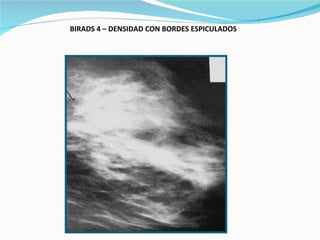BIRADS 4 – DENSIDAD CON BORDES ESPICULADOS   