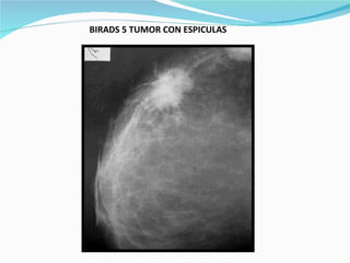 BIRADS 5 TUMOR CON ESPICULAS   