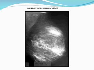 BIRADS 5 NODULOS MALIGNOS   