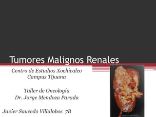 Tumores Malignos Renales
Centro de Estudios Xochicalco
Campus Tijuana
Taller de Oncología
Dr. Jorge Mendoza Parada
Javier Saucedo Villalobos 7B
 