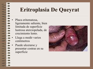 Eritroplasia De Queyrat <ul><li>P laca eritematosa, ligeramente saliente, bien limitada de superficie lustrosa aterciopela...