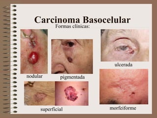 Carcinoma Basocelular superficial Formas clínicas: pigmentada ulcerada morfeiforme nodular 