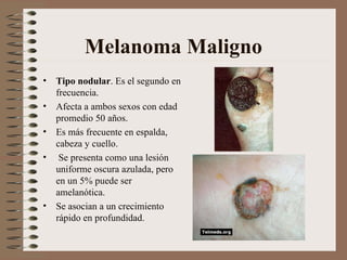 Melanoma Maligno <ul><li>Tipo nodular . Es el segundo en frecuencia. </li></ul><ul><li>Afecta a ambos sexos con edad prome...
