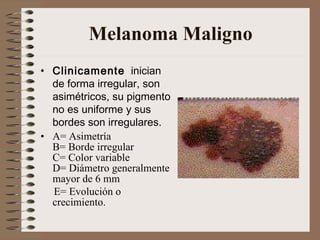 Melanoma Maligno <ul><li>Clinicamente   inician de forma irregular, son asimétricos, su pigmento no es uniforme y sus bord...