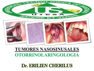TUMORES NASOSINUSALES
OTORRINOLARINGOLOGIA
Dr. ERILIEN CHERILUS

 