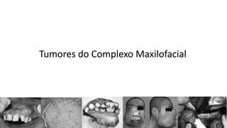 Tumores do Complexo Maxilofacial
 