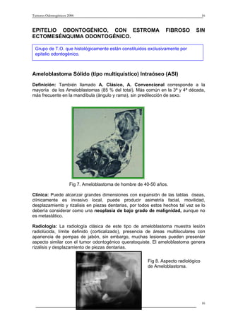 Tumores Odontogénicos 2006                                                             16



EPITELIO ODONTOGÉNICO, CON ESTROMA                                FIBROSO        SIN
ECTOMESÉNQUIMA ODONTOGÉNICO.

 Grupo de T.O. que histológicamente están constituidos exclusivamente por
AMELOBLASTOMA SÓLIDO (TIPO MULTIQUÍSTICO) INTRAÓSEO (ASI)
 epitelio odontogénico.



Ameloblastoma Sólido (tipo multiquístico) Intraóseo (ASI)

Definición: También llamado A. Clásico, A. Convencional corresponde a la
mayoría de los Ameloblastomas (85 % del total). Más común en la 3ª y 4ª década,
más frecuente en la mandíbula (ángulo y rama), sin predilección de sexo.




                       Fig 7. Ameloblastoma de hombre de 40-50 años.

Clínica: Puede alcanzar grandes dimensiones con expansión de las tablas óseas,
clínicamente es invasivo local, puede producir asimetría facial, movilidad,
desplazamiento y rizalisis en piezas dentarias, por todos estos hechos tal vez se lo
debería considerar como una neoplasia de bajo grado de malignidad, aunque no
es metastático.

Radiología: La radiología clásica de este tipo de ameloblastoma muestra lesión
radiolúcida, límite definido (corticalizado), presencia de áreas multiloculares con
apariencia de pompas de jabón, sin embargo, muchas lesiones pueden presentar
aspecto similar con el tumor odontogénico queratoquiste. El ameloblastoma genera
rizalisis y desplazamiento de piezas dentarias.


                                                          Fig 8. Aspecto radiológico
                                                          de Ameloblastoma.




                                                                                       16
 