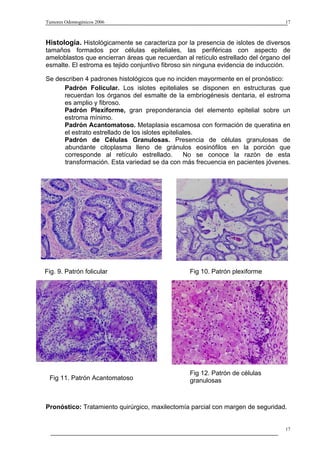 Tumores Odontogénicos 2006                                                        17



Histología. Histológicamente se caracteriza por la presencia de islotes de diversos
tamaños formados por células epiteliales, las periféricas con aspecto de
ameloblastos que encierran áreas que recuerdan al retículo estrellado del órgano del
esmalte. El estroma es tejido conjuntivo fibroso sin ninguna evidencia de inducción.

Se describen 4 padrones histológicos que no inciden mayormente en el pronóstico:
      Padrón Folicular. Los islotes epiteliales se disponen en estructuras que
      recuerdan los órganos del esmalte de la embriogénesis dentaria, el estroma
      es amplio y fibroso.
      Padrón Plexiforme, gran preponderancia del elemento epitelial sobre un
      estroma mínimo.
      Padrón Acantomatoso. Metaplasia escamosa con formación de queratina en
      el estrato estrellado de los islotes epiteliales.
      Padrón de Células Granulosas. Presencia de células granulosas de
      abundante citoplasma lleno de gránulos eosinófilos en la porción que
      corresponde al retículo estrellado.          No se conoce la razón de esta
      transformación. Esta variedad se da con más frecuencia en pacientes jóvenes.




Fig. 9. Patrón folicular                         Fig 10. Patrón plexiforme




                                                 Fig 12. Patrón de células
 Fig 11. Patrón Acantomatoso                     granulosas



Pronóstico: Tratamiento quirúrgico, maxilectomía parcial con margen de seguridad.


                                                                                  17
 
