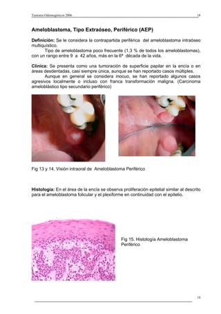 Tumores Odontogénicos 2006                                                             18



Ameloblastoma, Tipo Extraóseo, Periférico (AEP)
Definición: Se le considera la contrapartida periférica del ameloblastoma intraóseo
multiquístico.
       Tipo de ameloblastoma poco frecuente (1.3 % de todos los ameloblastomas),
con un rango entre 9 a 42 años, más en la 6ª década de la vida.

Clínica: Se presenta como una tumoración de superficie papilar en la encía o en
áreas desdentadas, casi siempre única, aunque se han reportado casos múltiples.
      Aunque en general se considera inocuo, se han reportado algunos casos
agresivos localmente o incluso con franca transformación maligna. (Carcinoma
ameloblástico tipo secundario periférico)




Fig 13 y 14. Visión intraoral de Ameloblastoma Periférico



Histología: En el área de la encía se observa proliferación epitelial similar al descrito
para el ameloblastoma folicular y el plexiforme en continuidad con el epitelio.




                                               Fig 15. Histología Ameloblastoma
                                               Periférico




                                                                                       18
 
