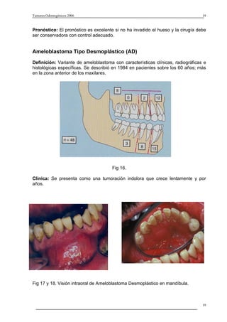 Tumores Odontogénicos 2006                                                       19



Pronóstico: El pronóstico es excelente si no ha invadido el hueso y la cirugía debe
ser conservadora con control adecuado.


Ameloblastoma Tipo Desmoplástico (AD)
Definición: Variante de ameloblastoma con características clínicas, radiográficas e
histológicas específicas. Se describió en 1984 en pacientes sobre los 60 años; más
en la zona anterior de los maxilares.




                                      Fig 16.

Clínica: Se presenta como una tumoración indolora que crece lentamente y por
años.




Fig 17 y 18. Visión intraoral de Ameloblastoma Desmoplástico en mandíbula.



                                                                                 19
 