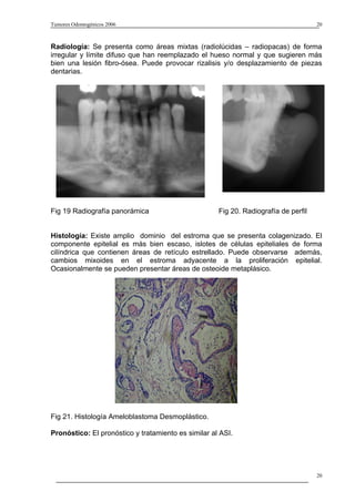 Tumores Odontogénicos 2006                                                           20



Radiología: Se presenta como áreas mixtas (radiolúcidas – radiopacas) de forma
irregular y límite difuso que han reemplazado el hueso normal y que sugieren más
bien una lesión fibro-ósea. Puede provocar rizalisis y/o desplazamiento de piezas
dentarias.




Fig 19 Radiografía panorámica                        Fig 20. Radiografía de perfil


Histología: Existe amplio dominio del estroma que se presenta colagenizado. El
componente epitelial es más bien escaso, islotes de células epiteliales de forma
cilíndrica que contienen áreas de retículo estrellado. Puede observarse además,
cambios mixoides en el estroma adyacente a la proliferación epitelial.
Ocasionalmente se pueden presentar áreas de osteoide metaplásico.




Fig 21. Histología Ameloblastoma Desmoplástico.

Pronóstico: El pronóstico y tratamiento es similar al ASI.




                                                                                     20
 