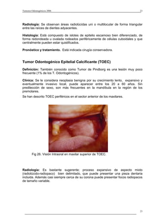 Tumores Odontogénicos 2006                                                     23




Radiología: Se observan áreas radiolúcidas uni o multilocular de forma triangular
entre las raíces de dientes adyacentes.

Histología: Está compuesto de islotes de epitelio escamoso bien diferenciado, de
forma redondeada u ovalada rodeados periféricamente de células cuboidales y que
centralmente pueden estar quistificados.

Pronóstico y tratamiento. Está indicada cirugía conservadora.


Tumor Odontogénico Epitelial Calcificante (TOEC)
Definición: También conocido como Tumor de Pindborg es una lesión muy poco
frecuente (1% de los T. Odontogénicos).

Clínica: Se le considera neoplasia benigna por su crecimiento lento, expansivo y
eventualmente invasivo local, puede aparecer entre los 20 a 60 años. Sin
predilección de sexo, son más frecuentes en la mandíbula en la región de los
premolares.
Se han descrito TOEC periféricos en el sector anterior de los maxilares.




        Fig 26. Visión Intraoral en maxilar superior de TOEC.



Radiología: Es bastante sugerente; proceso expansivo de aspecto mixto
(radiolúcido-radiopaco) bien delimitado, que puede presentar una pieza dentaria
incluida. Además casi siempre cerca de su corona puede presentar focos radiopacos
de tamaño variable.




                                                                               23
 