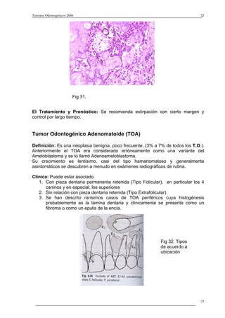 Tumores Odontogénicos 2006                                                      25




                         Fig 31.


El Tratamiento y Pronóstico: Se recomienda extirpación con cierto margen y
control por largo tiempo.


Tumor Odontogénico Adenomatoide (TOA)

Definición: Es una neoplasia benigna, poco frecuente, (3% a 7% de todos los T.O.).
Anteriormente el TOA era considerado erróneamente como una variante del
Ameloblastoma y se lo llamó Adenoameloblastoma.
Su crecimiento es lentísimo, casi del tipo hamartomatoso y generalmente
asintomáticos se descubren a menudo en exámenes radiográficos de rutina.

Clínica: Puede estar asociado
   1. Con pieza dentaria permanente retenida (Tipo Folicular), en particular los 4
      caninos y en especial, los superiores
   2. Sin relación con pieza dentaria retenida (Tipo Extrafolicular)
   3. Se han descrito rarísimos casos de TOA periféricos cuya histogénesis
      probablemente es la lámina dentaria y clínicamente se presenta como un
      fibroma o como un epulis de la encía.




                                                             Fig 32. Tipos
                                                             de acuerdo a
                                                             ubicación




                                                                                25
 