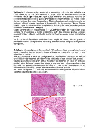 Tumores Odontogénicos 2006                                                          26



Radiología: La imagen más característica es un área unilocular bien definida, que
rodea la corona de una pieza dentaria no erupcionada en estas circunstancias se
denomina “TOA tipo Folicular” que puede contener una cantidad variable de
pequeños focos radiopacos y que ha provocado desplazamiento de las raíces de dos
dientes vecinos. Con gran frecuencia el TOA se localiza en el maxilar superior en
posición “glóbulo maxilar (alusión a la localización del denominado “Quiste Glóbulo
maxilar” que actualmente no se acepta como entidad). Se debe hacer Diagnóstico
diferencial con el Quiste Dentígero.
La otra variante (menos frecuente) es el “TOA extrafolicular” sin relación con pieza
dentaria no erupcionada y tiende a localizarse entre las raíces de piezas dentarias
desplazándolas y el área radiolúcida puede confundirse con un quiste periodóntico
lateral.
Los focos de calcificación se describen como “copos de nieve” pero su presencia
puede ser mínima o simplemente no estar y en este caso se complica el diagnóstico
radiográfico.


Histología: Macroscópicamente cuando el TOA está asociado a una pieza dentaria
no erupcionada y esta se extrae junto con el tumor, se comprueba que ésta no está
adherida a la lesión.
Microscópicamente el TOA es patognomónico; proliferación capsulada de células
epiteliales que se disponen en crecimientos nodulares en dos tipos de estructuras:
Células epiteliales que adoptan formas fusadas y se disponen en áreas en forma de
roseta y otras de forma más de tipo cúbico o columnar que rodean espacios de tipo
glandular que algunos suponen preameloblastos y que serían responsables de las
pequeñas calcificaciones que se interpretan como esmalte abortivo.
Por último en algunos TOA otro tipo de calcificaciones más grandes cuya naturaleza
distrófica o dentinoide esta en discusión.




                                                                     Fig 33 y 34.




                                                                                    26
 