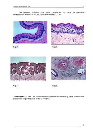 Tumores Odontogénicos 2006                                                 28



      Las lesiones quísticas que están recubiertas por capa de queratina
ortoqueratinizada no deben ser consideradas como TOQ.




Fig 35.                                  Fig 36.




Fig 37.                                  Fig 38.




Tratamiento: El TOQ es potencialmente agresivo localmente y debe tratarse con
margen de seguridad para evitar la recidiva.




                                                                           28
 