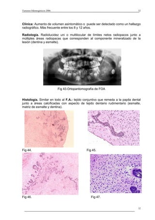 Tumores Odontogénicos 2006                                                        32




Clínica: Aumento de volumen asintomático o puede ser detectado como un hallazgo
radiográfico. Más frecuente entre los 8 y 12 años.

Radiología. Radiolucidez uni o multilocular de límites netos radiopacos junto a
múltiples áreas radiopacas que corresponden al componente mineralizado de la
lesión (dentina y esmalte).




                             Fig 43.Ortopantomografía de FOA


Histología. Similar en todo al F.A.: tejido conjuntivo que remeda a la papila dental
junto a áreas calcificadas con aspecto de tejido dentario rudimentario (esmalte,
matriz de esmalte y dentina).




Fig 44.                                        Fig 45.




Fig 46.                                           Fig 47.


                                                                                  32
 