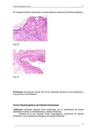 Tumores Odontogénicos 2006                                                        36



En el tejido conjuntivo adyacente se puede observar presencia de dentina displásica.




Fig. 52




Fig. 53




Pronóstico. Enucleación simple. No se han reportado recidivas en los periféricos y
muy pocos en los intraóseos.




Tumor Dentinogénico de Células Fantasmas
 Definición: neoplasia agresiva local conformada por la proliferación de islotes
epiteliales similares al ameloblastoma y células fantasmas.
        También se le han llamado Tumor Odontogénico calcificante de células
fantasmas, Tumor epitelial odontogénico de células fantasmas.



                                                                                  36
 