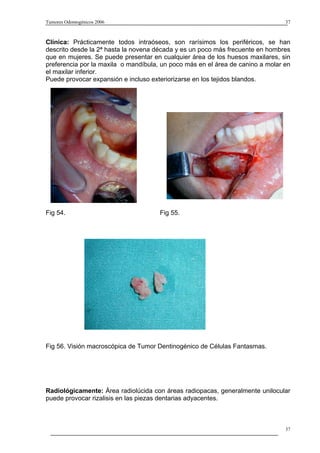 Tumores Odontogénicos 2006                                                      37



Clínica: Prácticamente todos intraóseos, son rarísimos los periféricos, se han
descrito desde la 2ª hasta la novena década y es un poco más frecuente en hombres
que en mujeres. Se puede presentar en cualquier área de los huesos maxilares, sin
preferencia por la maxila o mandíbula, un poco más en el área de canino a molar en
el maxilar inferior.
Puede provocar expansión e incluso exteriorizarse en los tejidos blandos.




Fig 54.                               Fig 55.




Fig 56. Visión macroscópica de Tumor Dentinogénico de Células Fantasmas.




Radiológicamente: Área radiolúcida con áreas radiopacas, generalmente unilocular
puede provocar rizalisis en las piezas dentarias adyacentes.



                                                                                37
 