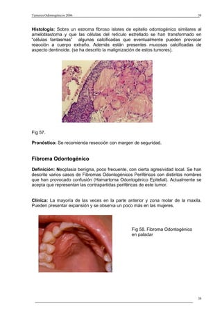 Tumores Odontogénicos 2006                                                       38



Histología: Sobre un estroma fibroso islotes de epitelio odontogénico similares al
ameloblastoma y que las células del retículo estrellado se han transformado en
“células fantasmas” algunas calcificadas que eventualmente pueden provocar
reacción a cuerpo extraño. Además están presentes mucosas calcificadas de
aspecto dentinoide. (se ha descrito la malignización de estos tumores).




Fig 57.

Pronóstico: Se recomienda resección con margen de seguridad.


Fibroma Odontogénico
Definición: Neoplasia benigna, poco frecuente, con cierta agresividad local. Se han
descrito varios casos de Fibromas Odontogénicos Periféricos con distintos nombres
que han provocado confusión (Hamartoma Odontogénico Epitelial). Actualmente se
acepta que representan las contrapartidas periféricas de este tumor.


Clínica: La mayoría de las veces en la parte anterior y zona molar de la maxila.
Pueden presentar expansión y se observa un poco más en las mujeres.




                                                Fig 58. Fibroma Odontogénico
                                                en paladar




                                                                                 38
 