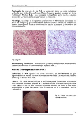 Tumores Odontogénicos 2006                                                       39



Radiología. La mayoría de los F.O. se presentan como un área radiolúcida
unilocular con límites bien definidos. Menos frecuente pueden aparecer en forma
multilocular. Muchos F.O. son hallazgos radiográficos, pero pueden provocar
expansión. La rizalisis de las piezas vecinas es frecuente.

Histología. Es simple e inespecífica: proliferación de fibroblastos separados por
áreas de colágeno y que eventualmente contiene además islotes y/o cordones de
epitelio odontogénico inactivo compuestos de células cuboidales y columnares sin
retículo estrellado.




Fig 59 y 60

Tratamiento y Pronóstico. La enucleación y curetaje enérgico son recomendables
dada la característica de crecimiento algo agresiva del F.O.

Mixoma Odontogénico/Mixofibroma

Definición: El M.O. aparece con cierta frecuencia, es característica su gran
agresividad local, incluso superior al ameloblastoma sólido. La mayoría se presenta
en la 2° y 3° década de la vida.

Clínica: Con cierta predilección por la mandíbula puede presentarse en cualquier
área de ambos maxilares. Algunos M.O. se detectan con exámenes radiográficos de
rutina, pero muchos de ellos producen expansión indolora del hueso y a veces es
sorprendente el gran compromiso que se constata en el consecuente estudio
radiográfico.


                                                       Fig 61. Visión macróscopica
                                                       de Mixofibroma




                                                                                 39
 