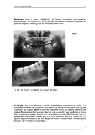 Tumores Odontogénicos 2006                                                     40




Radiología. Área o áreas radiolúcidas de bordes irregulares que provocan
desplazamiento y/o reabsorción de raíces. Muchos pueden presentar un padrón en
“pompas de jabón” indistinguible del Ameloblastoma sólido.




                                                                 Fig 62.




Fig 63 y 64. Visión mandibular en pompas de jabón.




Histología. Sobre un estroma conectivo mixomatoso prácticamente celular, con
cantidades variables de colágeno y una matriz de muco polisacáridos con algunos
fibroblastos se pueden observar además pequeños islotes de epitelio odontogénico
inactivo. Nunca presentan cápsula. Algunos M.O. presentan gran tendencia a formar
fibras colágenas y a veces se designan como Fibromixomas o Mixofibromas, pero no
representan una entidad distinta. Algunos M.O. muestran marcada celularidad con
algunas atipías nucleares y se han designado como Mixosarcomas recurrente pero
jamás se han demostrado metástasis.


                                                                               40
 