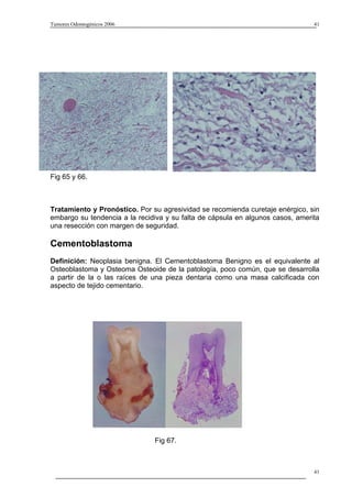 Tumores Odontogénicos 2006                                                      41




Fig 65 y 66.



Tratamiento y Pronóstico. Por su agresividad se recomienda curetaje enérgico, sin
embargo su tendencia a la recidiva y su falta de cápsula en algunos casos, amerita
una resección con margen de seguridad.

Cementoblastoma
Definición: Neoplasia benigna. El Cementoblastoma Benigno es el equivalente al
Osteoblastoma y Osteoma Osteoide de la patología, poco común, que se desarrolla
a partir de la o las raíces de una pieza dentaria como una masa calcificada con
aspecto de tejido cementario.




                               Fig 67.



                                                                                41
 