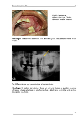 Tumores Odontogénicos 2006                                                             47




                                                       Fig 68.Carcinoma
                                                       Odontogénico de Células
                                                       claras en maxilar superior




Radiología: Radiolucidez de límites poco definidos y que produce reabsorción de las
raíces.




Fig 69.Panorámica correspondiente a la figura anterior.

Histología: El padrón es bifásico: Sobre un estroma fibroso se pueden observar
islotes de células epiteliales de citoplasma claro o débilmente eosinófilo, junto a otras
de aspecto basaloide.




                                                                                       47
 