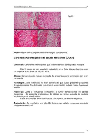 Tumores Odontogénicos 2006                                                         48




                                                             Fig 70.




Pronóstico: Como cualquier neoplasia maligna convencional.

Carcinoma Odontogénico de células fantasmas (COCF)

Definición: Carcinoma odontogénico que se considera de contrapartida maligna.

      Sólo 19 casos se han reportado, sobretodo en el Asia. Más en hombre entre
un rango de edad entre los 13 y 72 años.

Clínica: Se han descrito más en la maxila. Se presentan como tumoración con o sin
parestesia.

Radiología: Zona radiolúcida no bien demarcada que puede presentar pequeñas
áreas radiopacas. Puede invadir y destruir el seno maxilar, incluso invade fosa nasal
y órbita.

Histología: Junto a estructuras semejantes al tumor dentistogénico de células
fantasmas. Se presenta proliferación de células de forma redonda de núcleos
atípicos órganos y vesiculosas.
       Puede encontrarse áreas calcificadas con aspecto de dentina displásica.

Tratamiento: De pronóstico impredecible debería ser tratado como una neoplasia
maligna convencional.




                                                                                   48
 