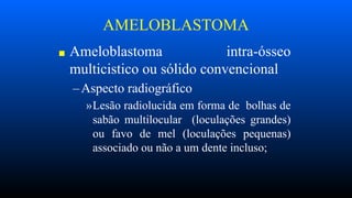AMELOBLASTOMA
■ Ameloblastoma intra-ósseo
multicistico ou sólido convencional
–Aspecto radiográfico
»Lesão radiolucida em forma de bolhas de
sabão multilocular (loculações grandes)
ou favo de mel (loculações pequenas)
associado ou não a um dente incluso;
 