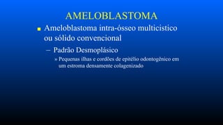 AMELOBLASTOMA
■ Ameloblastoma intra-ósseo multicistico
ou sólido convencional
– Padrão Desmoplásico
» Pequenas ilhas e cordões de epitélio odontogênico em
um estroma densamente colagenizado
 