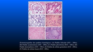 (Fotomicrografias dos padrões histológicos. (A) Padrão folicular (H/E - 200x);
(B) Padrão acantomatoso (H/E - 200x); (C) Padrão plexiforme (H/E - 100x); (D)
Padrão desmoplásico (H/E - 100x); (E) Padrão de células granulares (H/E - 200x);
(F) Padrão de células basais (H/E - 200x).
 