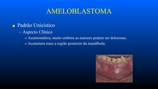 AMELOBLASTOMA
■ Padrão Unicístico
– Aspecto Clínico
» Assintomática, muito embora as maiores podem ser dolorosas;
» Acometem mais a região posterior da mandíbula;
 