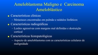 Ameloblastoma Maligno e Carcinoma
Ameloblástico
■ Características clínicas
– Metastases encontradas em pulmão e nódulos linfáticos
■ Caracteristicas radiográficas
– Lesões agressivas com margens mal definidas e destruição
cortical
■ Características histopatológicas
– Aspecto de ameloblastoma com as características celulares de
malignidade
 