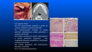 (A) Aspecto clinico
(B) ]TC demonstrando expansão e erosão da
cortical vestibular e matrial calcificado.
(C) Fotomicrografia exibindo as cordas
epiteliais odontogênicas, células granulares e
cemento calcificado.
(D) Celulas colunares do epitelio odontogênico
e celulas granulares polygonais com
citoplasma finamente eosinofilico e localização
excêntrica do núcleo.
(E) Células granulares cells PAS-positiva
(Periodic Acid-Shif).
(F) e (G) Immunohistoquimica.
 
